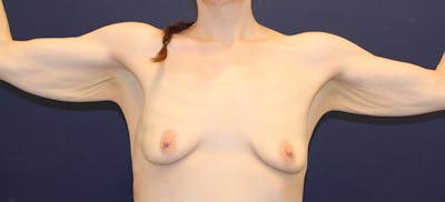 Arm Lift Before & After Gallery - Patient 243294 - Image 1