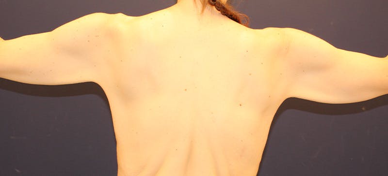 Arm Lift Before & After Gallery - Patient 243294 - Image 3