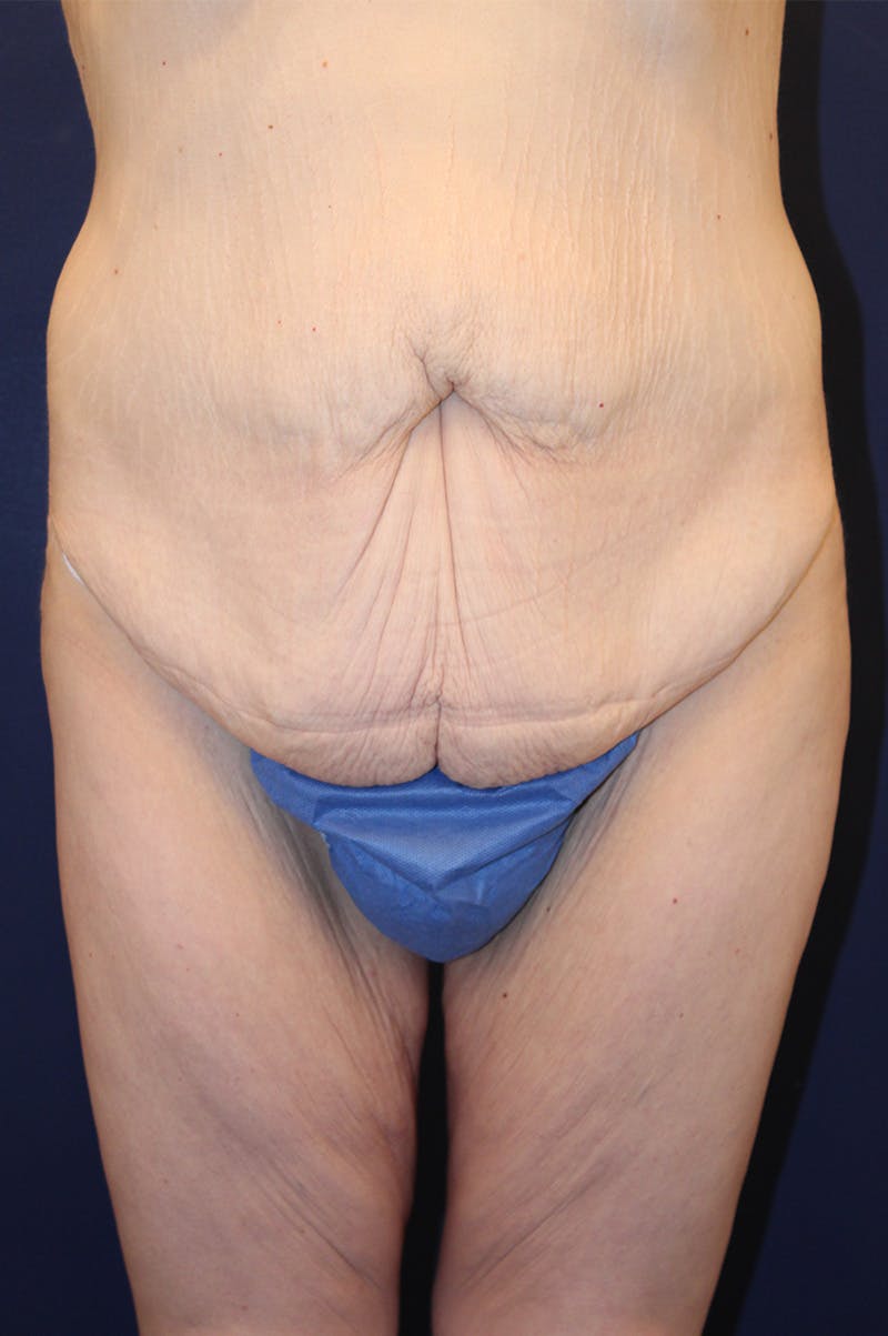 Massive Weight Loss Before & After Gallery - Patient 193385 - Image 1