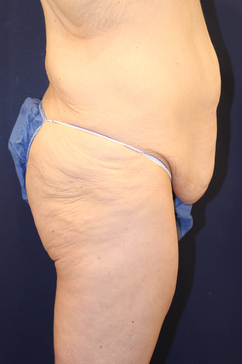 Massive Weight Loss Before & After Gallery - Patient 193385 - Image 5