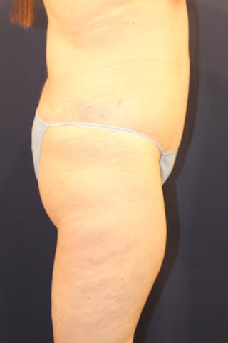 Massive Weight Loss Before & After Gallery - Patient 193385 - Image 6