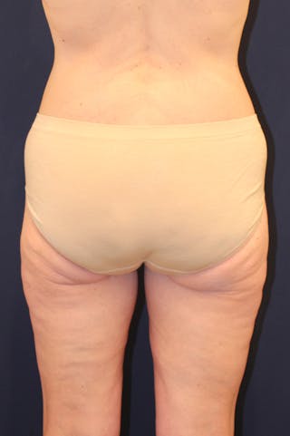 Thigh Lift Before & After Gallery - Patient 150634 - Image 8