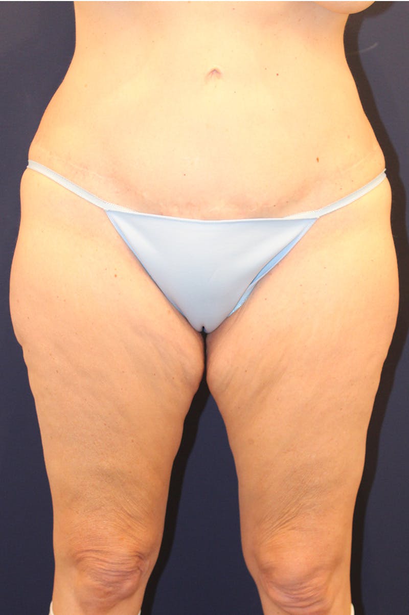 Thigh Lift Before & After Gallery - Patient 150634 - Image 1