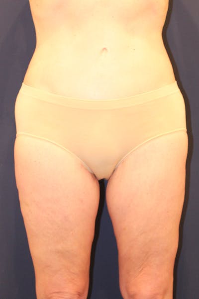Thigh Lift Before & After Gallery - Patient 150634 - Image 2