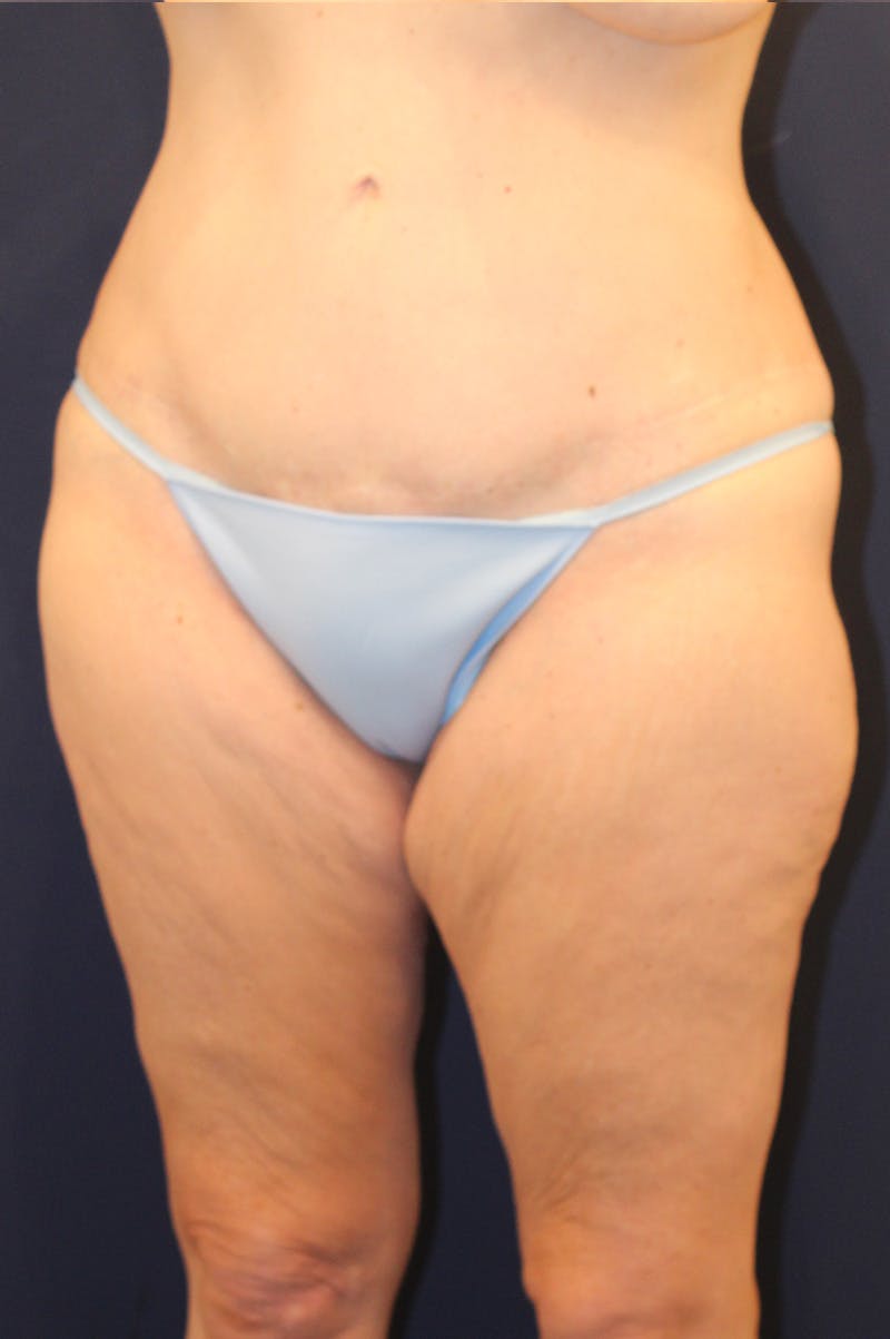 Thigh Lift Before & After Gallery - Patient 150634 - Image 5