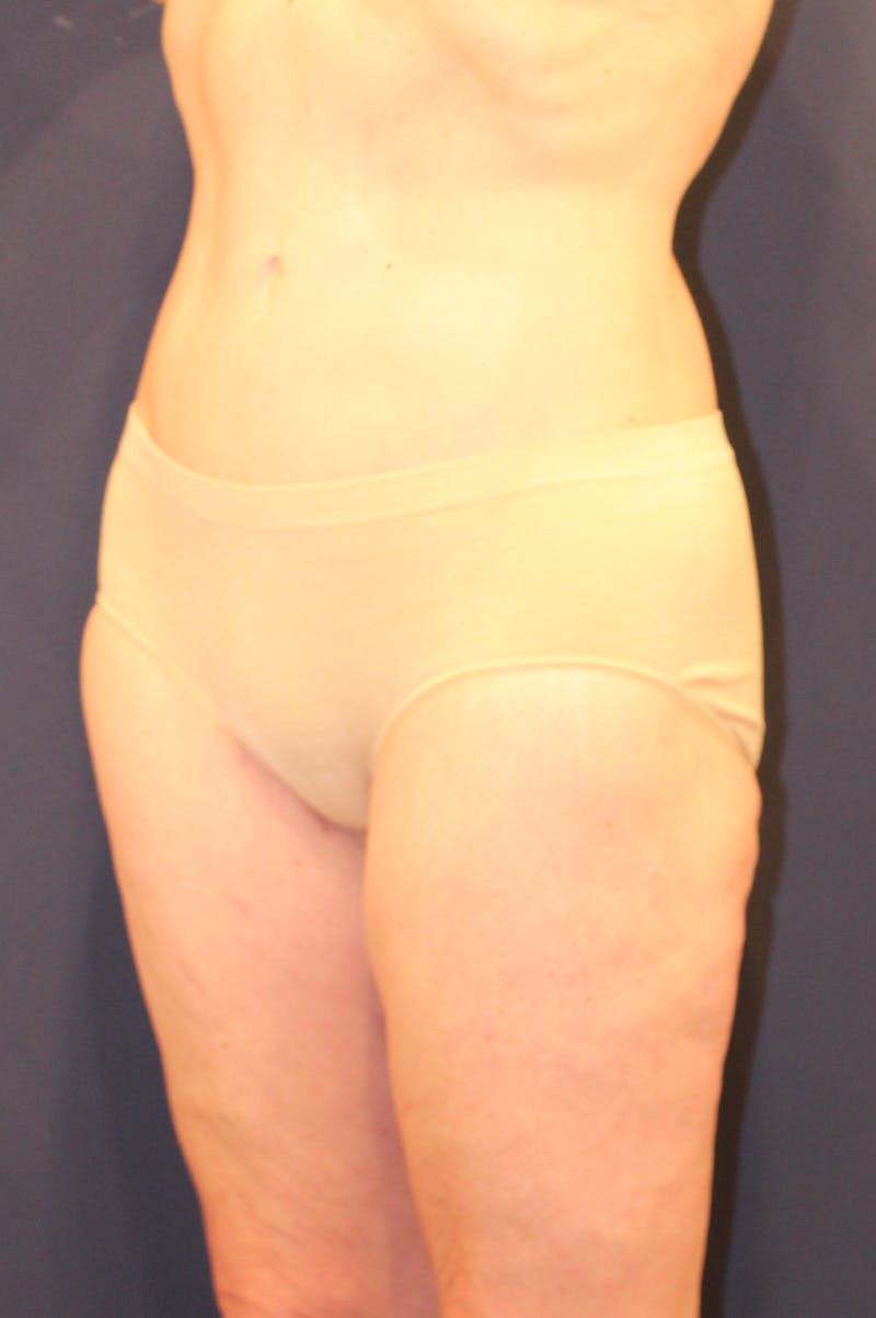 Thigh Lift Before & After Gallery - Patient 150634 - Image 6