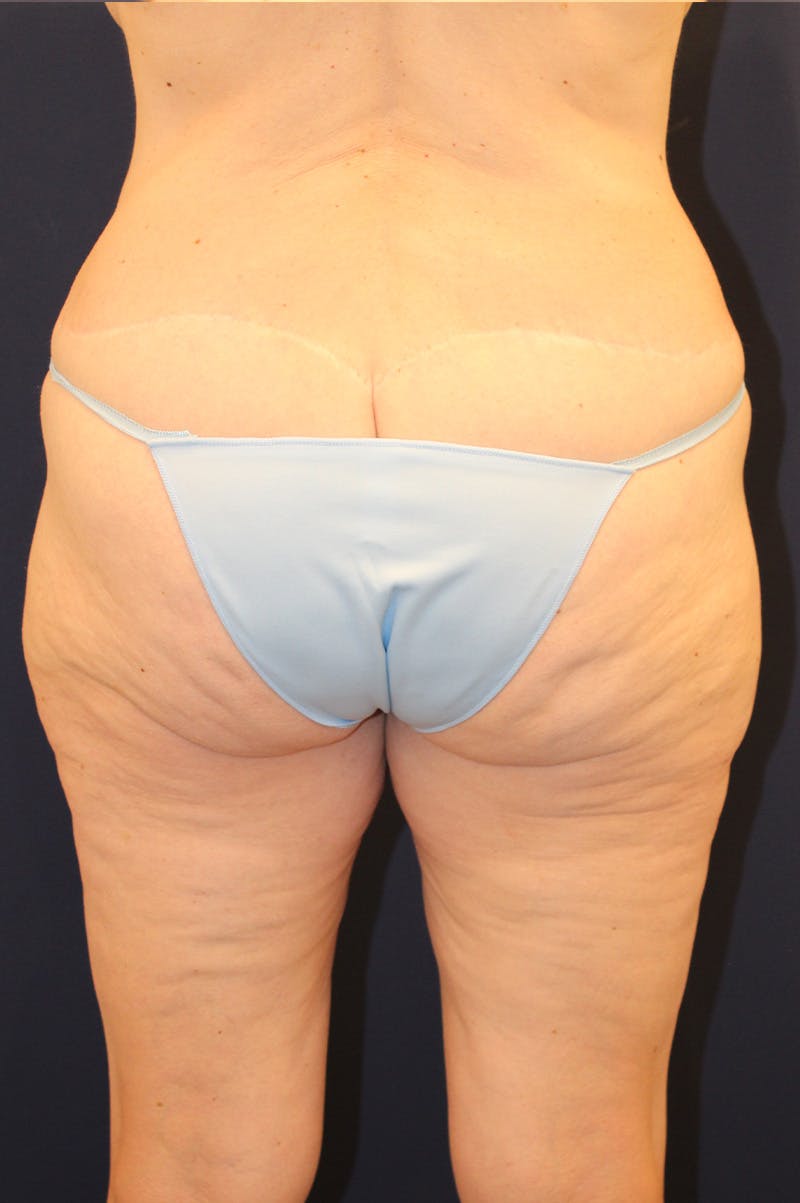 Thigh Lift Before & After Gallery - Patient 150634 - Image 7