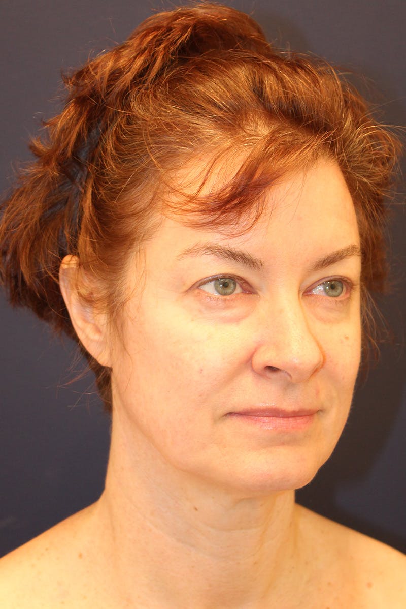 Necklift Before & After Gallery - Patient 279275 - Image 3