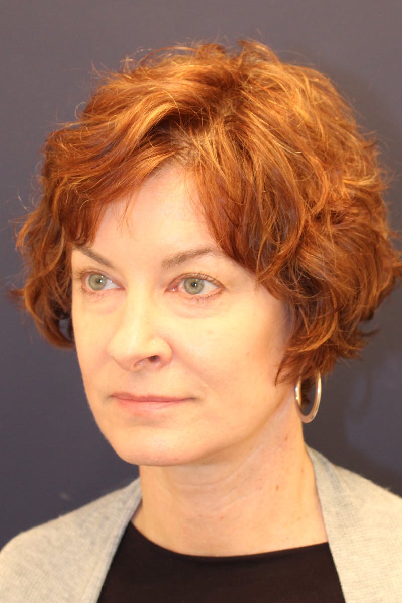 Necklift Before & After Gallery - Patient 279275 - Image 8