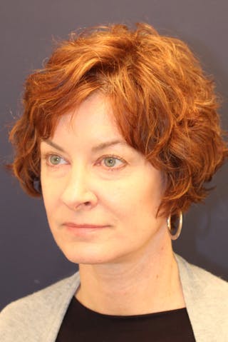 Necklift Before & After Gallery - Patient 279275 - Image 8