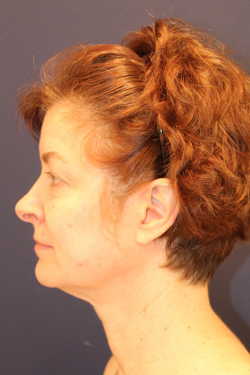 Necklift Before & After Gallery - Patient 279275 - Image 9