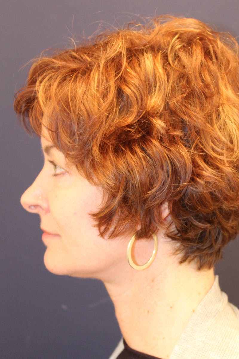 Necklift Before & After Gallery - Patient 279275 - Image 10