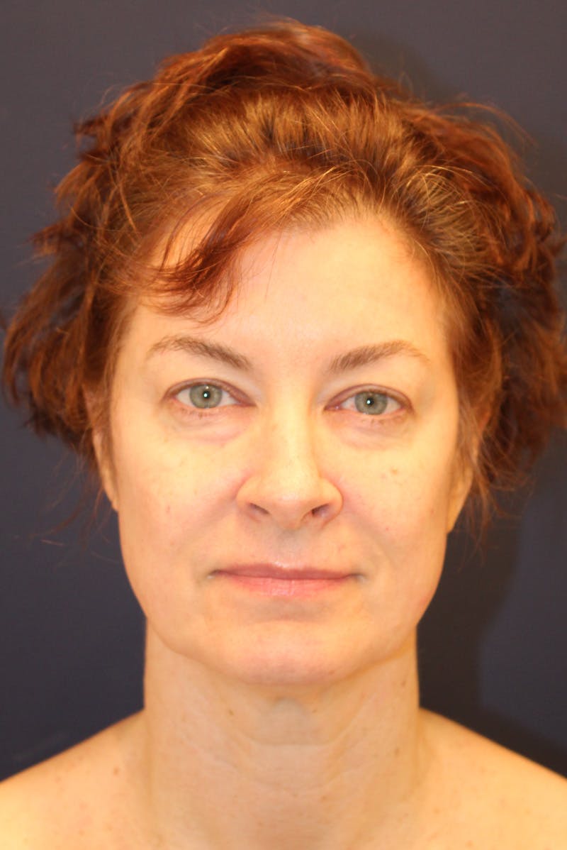 Necklift Before & After Gallery - Patient 279275 - Image 1