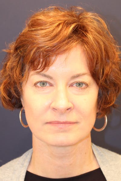 Necklift Before & After Gallery - Patient 279275 - Image 2