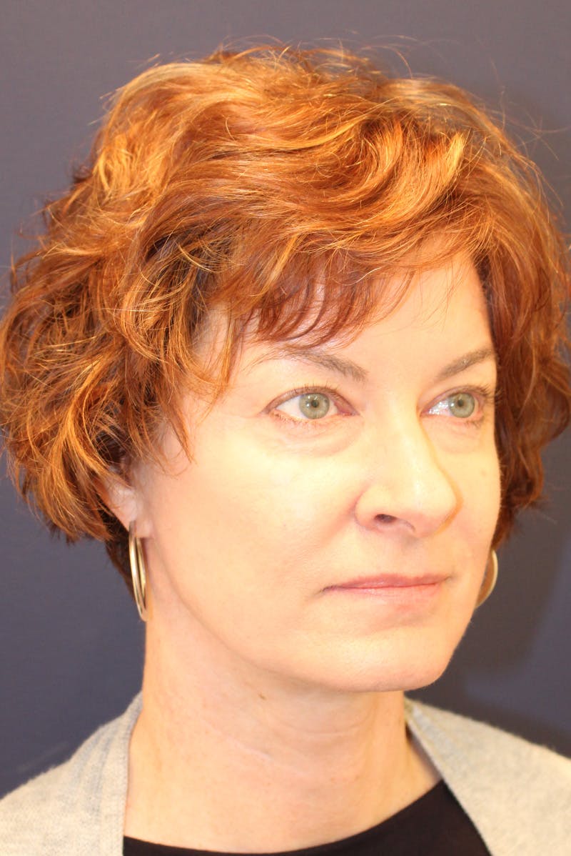 Necklift Before & After Gallery - Patient 279275 - Image 4