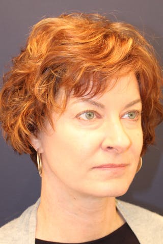Necklift Before & After Gallery - Patient 279275 - Image 4