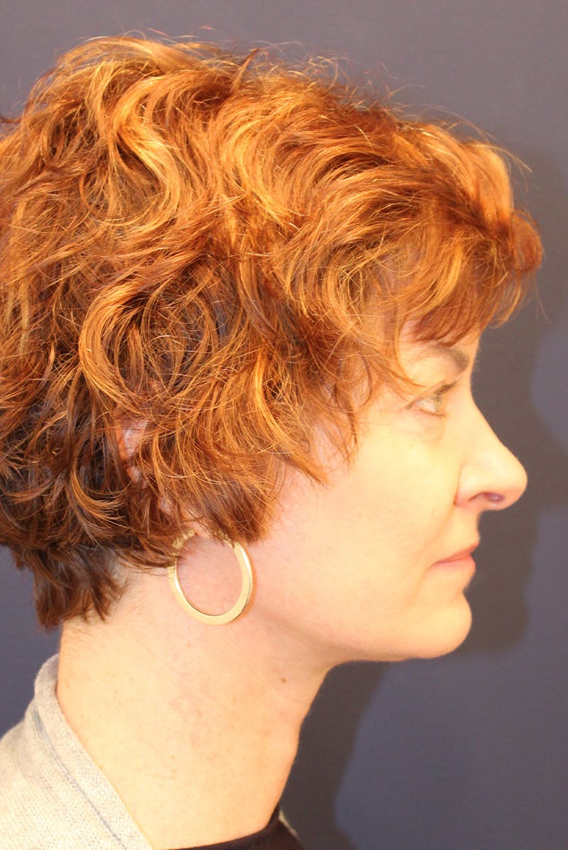 Necklift Before & After Gallery - Patient 279275 - Image 6