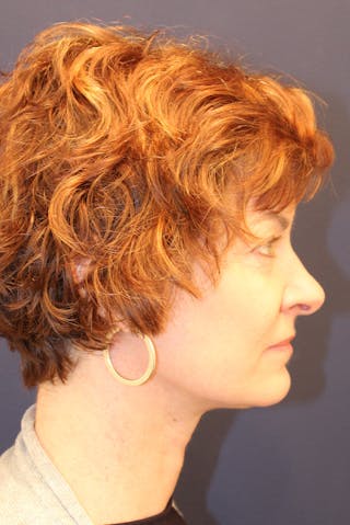 Necklift Before & After Gallery - Patient 279275 - Image 6