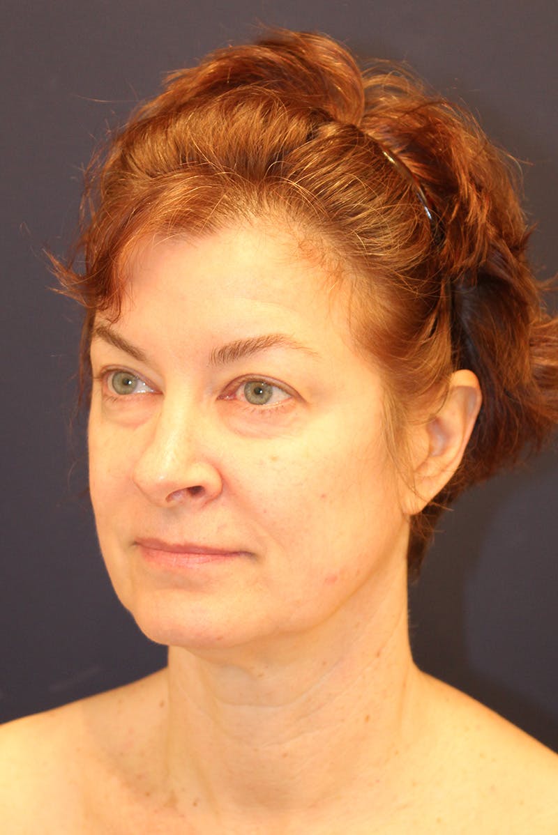 Necklift Before & After Gallery - Patient 279275 - Image 7