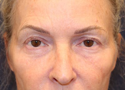 Eyelid Surgery Before & After Gallery - Patient 129826 - Image 1