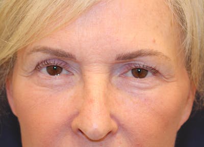 Eyelid Surgery Before & After Gallery - Patient 129826 - Image 2