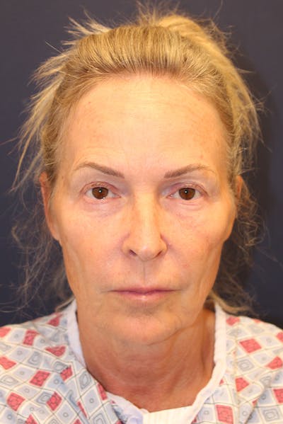 Facelift Before & After Gallery - Patient 120986 - Image 1