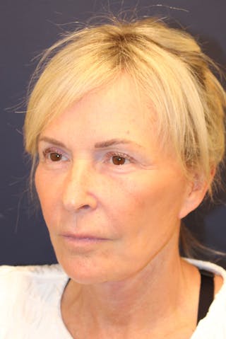 Facelift Before & After Gallery - Patient 120986 - Image 8