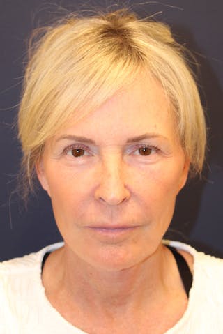 Facelift Before & After Gallery - Patient 120986 - Image 2
