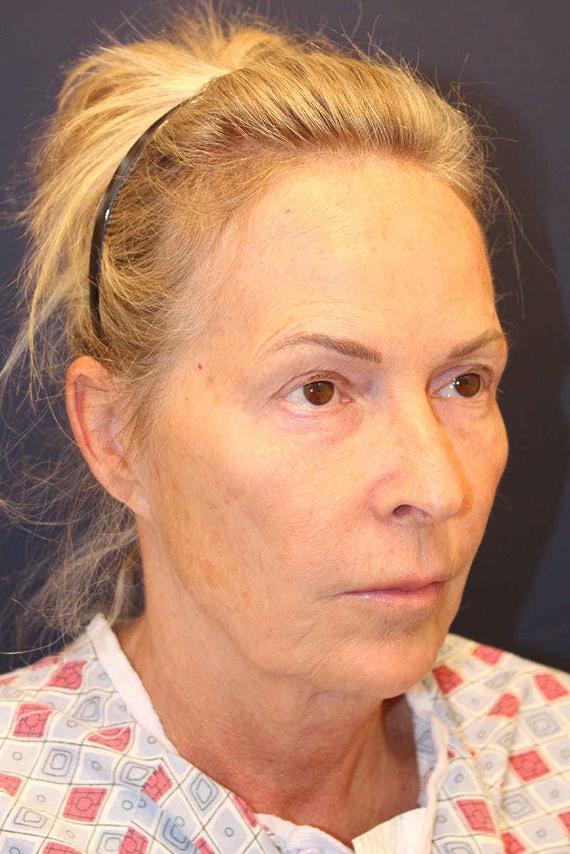 Facelift Before & After Gallery - Patient 120986 - Image 3