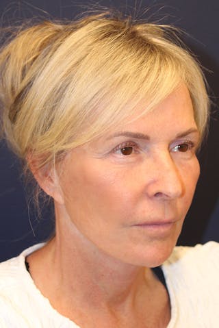 Facelift Before & After Gallery - Patient 120986 - Image 4