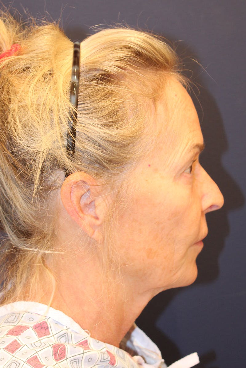 Facelift Before & After Gallery - Patient 120986 - Image 5