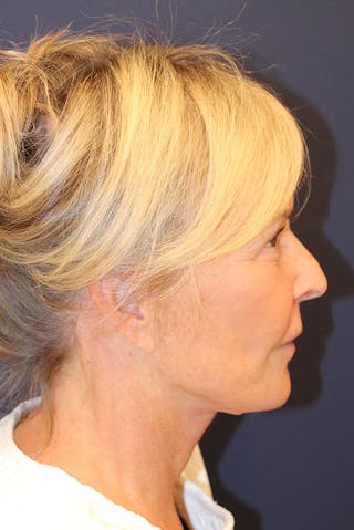 Facelift Before & After Gallery - Patient 120986 - Image 6
