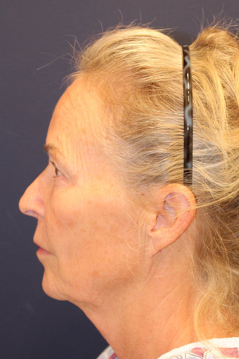 Facelift Before & After Gallery - Patient 120986 - Image 9