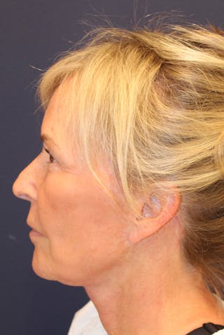 Facelift Before & After Gallery - Patient 120986 - Image 10
