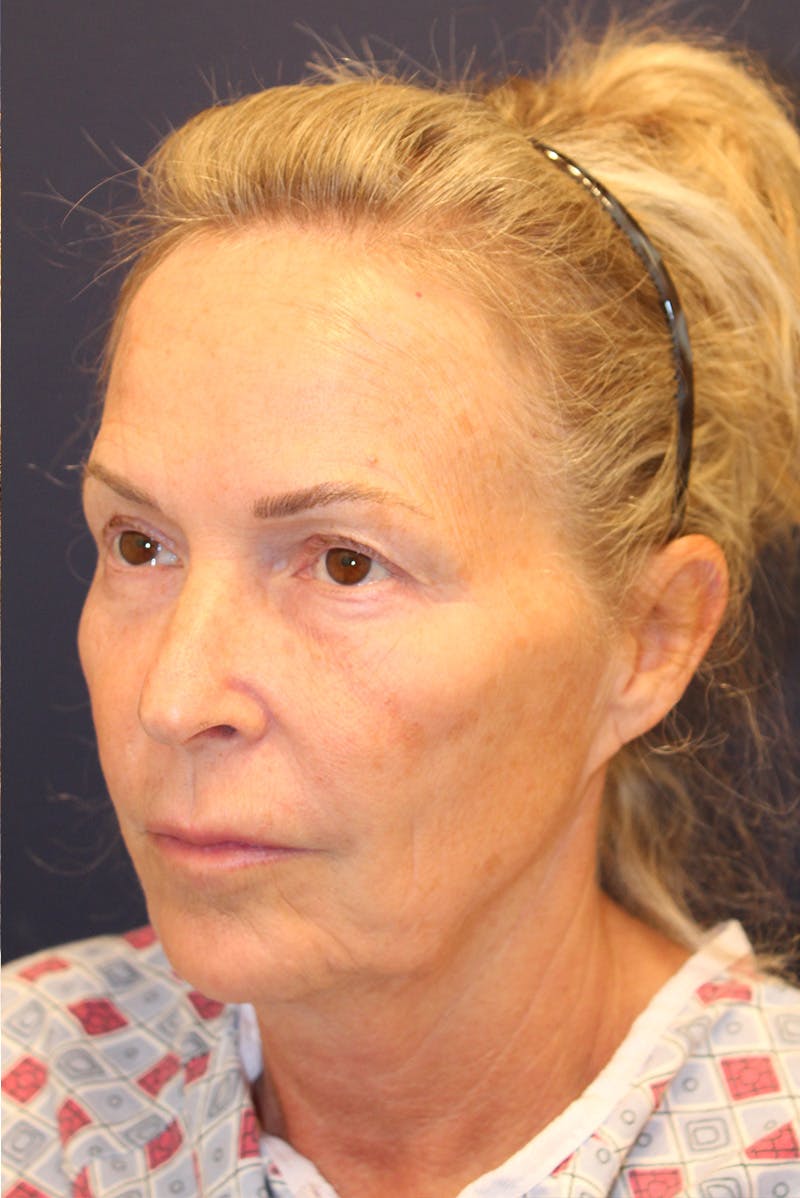 Facelift Before & After Gallery - Patient 120986 - Image 7
