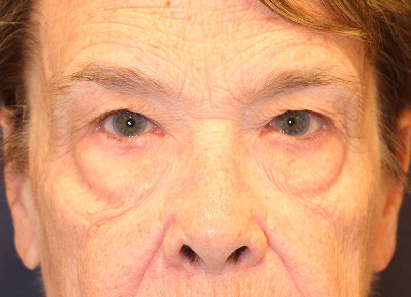 Brow Lift Before & After Gallery - Patient 373355 - Image 1