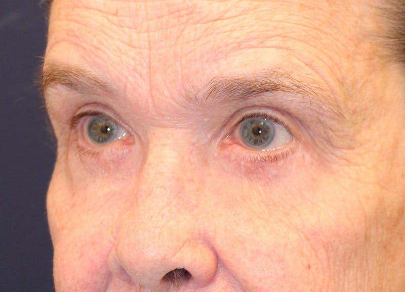 Brow Lift Before & After Gallery - Patient 373355 - Image 4