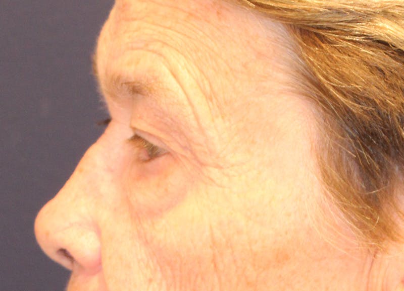 Brow Lift Before & After Gallery - Patient 373355 - Image 5