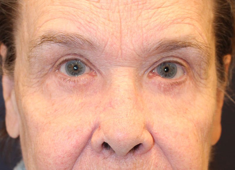 Brow Lift Before & After Gallery - Patient 373355 - Image 2