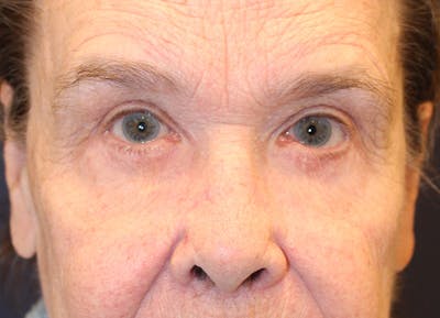 Eyelid Surgery Before & After Gallery - Patient 308675 - Image 2