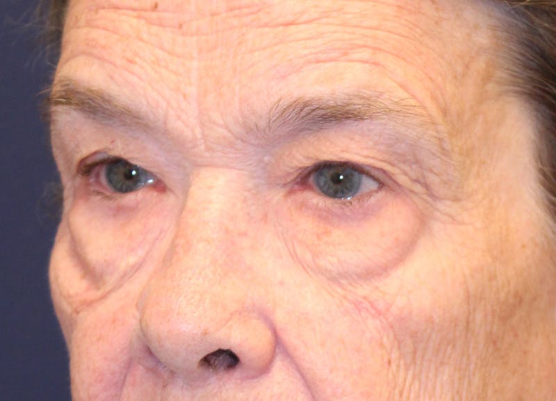 Brow Lift Before & After Gallery - Patient 373355 - Image 3