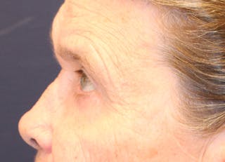 Eyelid Surgery Before & After Gallery - Patient 308675 - Image 6