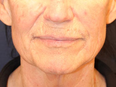 Peels Before & After Gallery - Patient 176849 - Image 1