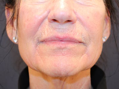 Peels Before & After Gallery - Patient 176849 - Image 2