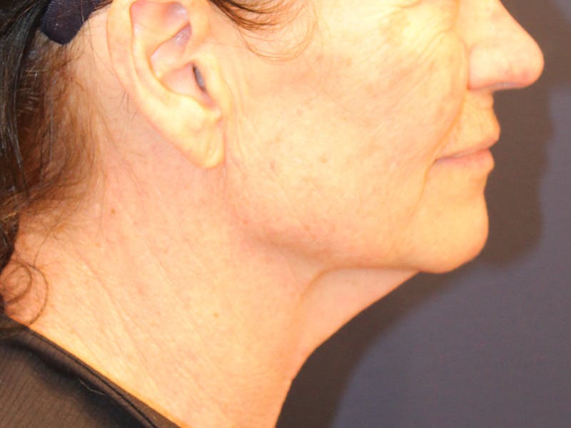 Peels Before & After Gallery - Patient 176849 - Image 3