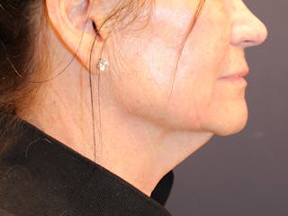 Peels Before & After Gallery - Patient 176849 - Image 4
