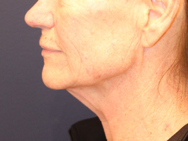 Peels Before & After Gallery - Patient 176849 - Image 5