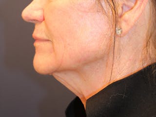 Peels Before & After Gallery - Patient 176849 - Image 6