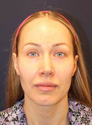 Peels Before & After Gallery - Patient 232957 - Image 2