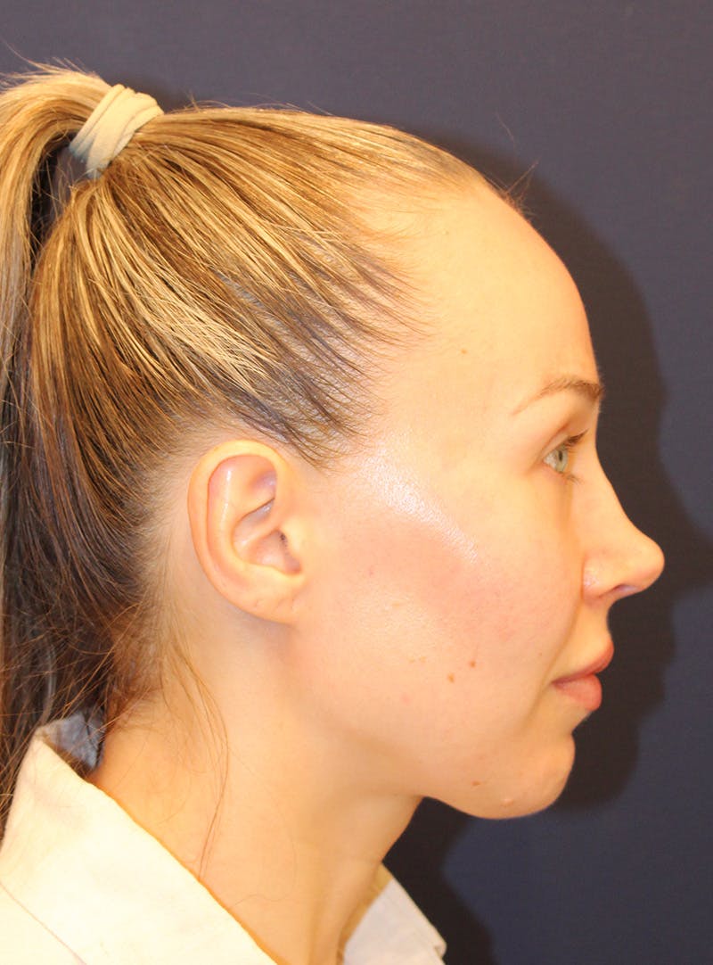 Peels Before & After Gallery - Patient 232957 - Image 5